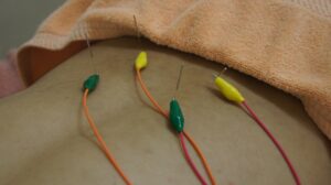 腰の鍼治療