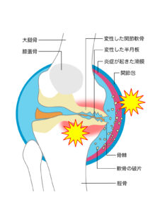 変形性膝関節症の図解