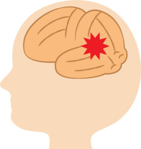 脳疾患による頭痛