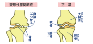 膝の変形による損傷