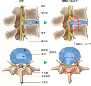 ヘルニアの図解