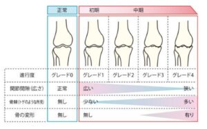 変形性膝関節症の段階
