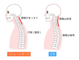 ストレートネック図解